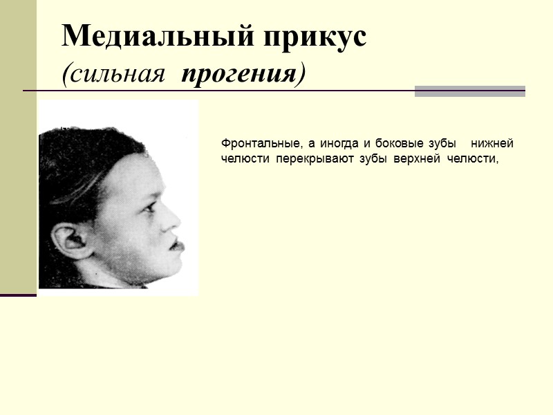 Медиальный прикус            